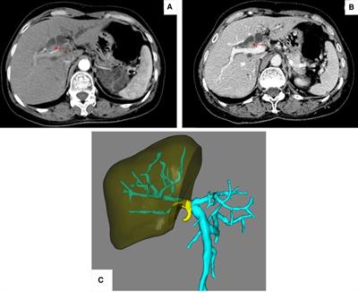 Case Report: Idiopathic Traumatic Neuroma of the Gallbladder Without Previous Surgery